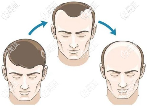 男士M型两额角脱发 男士M型两额角脱发