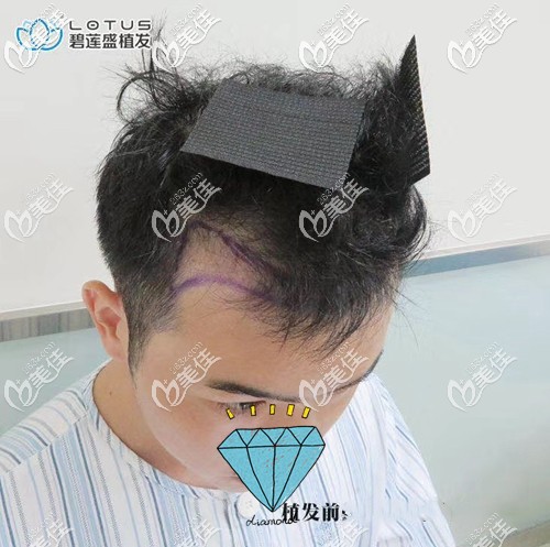 前额发际线种植术前设计 前额发际线种植术前设计