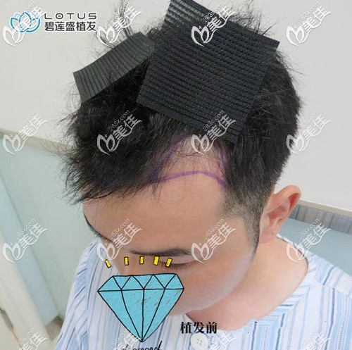 植发补额角手术前方案设计 植发补额角手术前方案设计