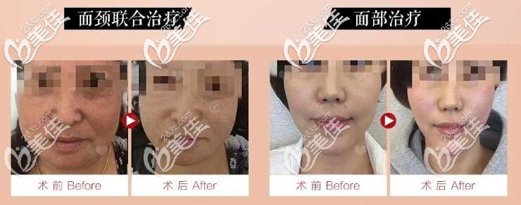 热玛吉效果对比图 热玛吉效果对比图