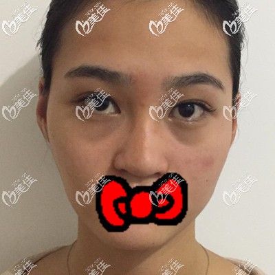 做自体脂肪面部填充术前照 做自体脂肪面部填充术前照