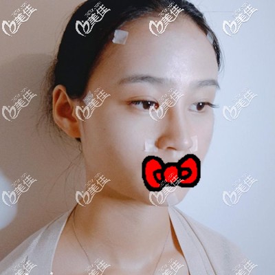 术后第3天 术后第3天