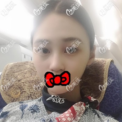 脂肪丰面部术后半个月效果展示 脂肪丰面部术后半个月效果展示