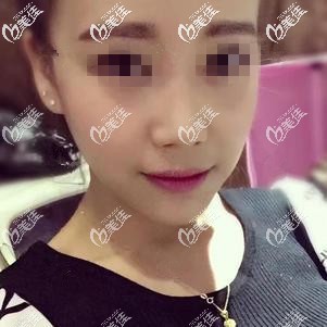 注射玻尿酸术前下巴短缩 注射玻尿酸术前下巴短缩