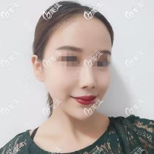 以我注射玻尿酸垫下巴的真实经历来看选择乔雅登好还是丝丽好