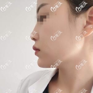 刚注射完乔雅登玻尿酸垫下巴后有点肿胀 刚注射完乔雅登玻尿酸垫下巴后有点肿胀