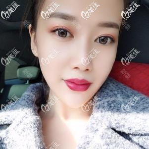 注射乔雅登玻尿酸垫下巴3天慢慢消肿 注射乔雅登玻尿酸垫下巴3天慢慢消肿