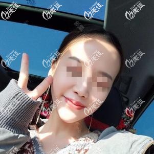 注射玻尿酸垫下巴术后一周效果明显 注射玻尿酸垫下巴术后一周效果明显