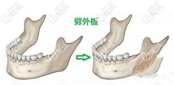 下颌角劈外板效果图 下颌角劈外板效果图