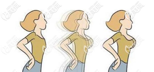 南宁密斯整形方观瑞做三维丰胸效果好不好