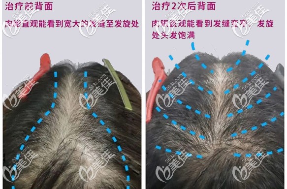 电波密发治疗2次效果对比图 电波密发治疗2次效果对比图