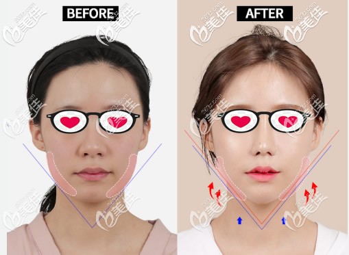 韩国ID医院削下颌骨案例 韩国ID医院削下颌骨案例