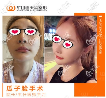 高俊明V-line瓜子脸整形前后对比照片 高俊明V-line瓜子脸整形前后对比照片