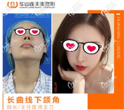 杭州华山连天高俊明长曲线下颌角截骨案例 杭州华山连天高俊明长曲线下颌角截骨案例