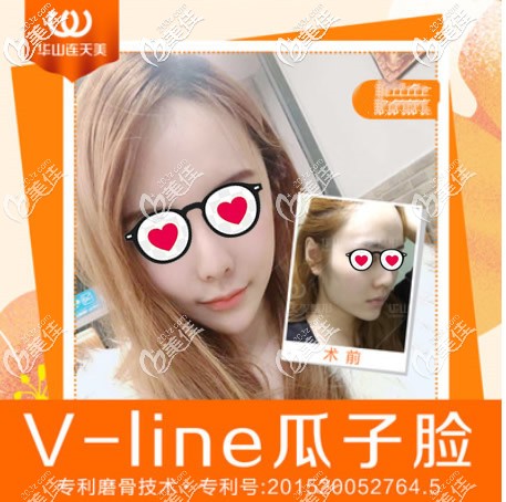 杭州华山连天美医院高俊明院长轮廓三件套效果 杭州华山连天美医院高俊明院长轮廓三件套效果