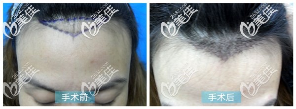 成都丝恒美人尖种植案例效果 成都丝恒美人尖种植案例效果