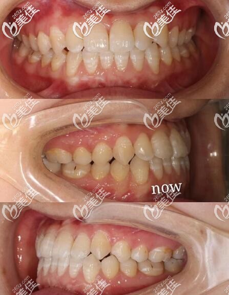 南京鼓楼美奥口腔隐适美隐形矫正反颌案例