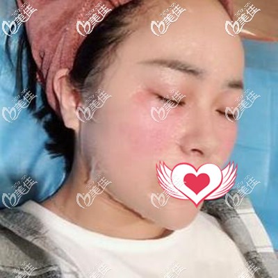 做皮秒术后即刻