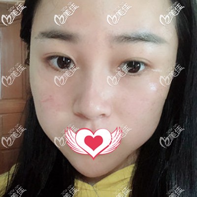 超皮秒术后3天效果