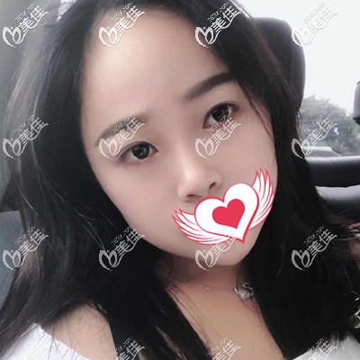 做完皮秒祛斑术后1个月效果