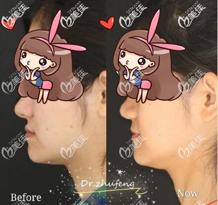 对比了南京正规牙科医院的价格后,反颌地包天姑娘选择在私立口腔做了隐适美矫正