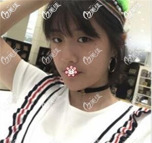 术前我的单眼皮 术前我的单眼皮