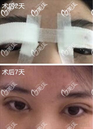 刚手术完样子 刚手术完样子