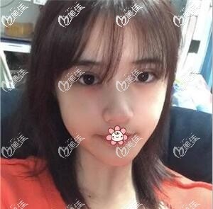 我在重庆军科整形割完双眼皮半个月了 我在重庆军科整形割完双眼皮半个月了