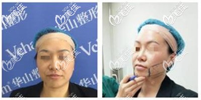 射频溶脂手术前 射频溶脂手术前