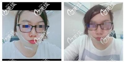 射频溶脂后戴头套 射频溶脂后戴头套