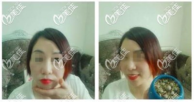 射频溶脂术后半个月恢复效果 射频溶脂术后半个月恢复效果