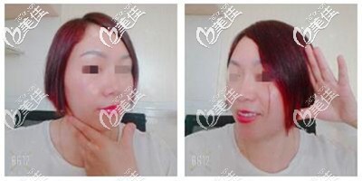 射频溶脂瘦脸术后1个月恢复效果 射频溶脂瘦脸术后1个月恢复效果