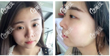 去韩国做面部吸脂术前照片 去韩国做面部吸脂术前照片