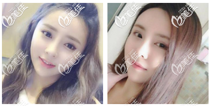 韩国明星线面吸一个月恢复效果图 韩国明星线面吸一个月恢复效果图