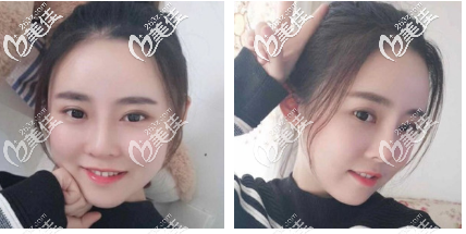 韩国做面吸做得好的医院韩国明星线整形医院面吸案例 韩国做面吸做得好的医院韩国明星线整形医院面吸案例