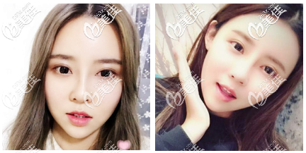 不知道韩国面吸哪家医院好?请参考我在韩国明星线做的面吸效果吧