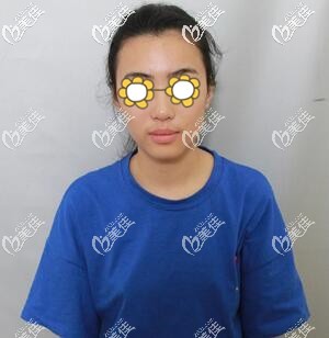 做假体隆胸术前照 做假体隆胸术前照