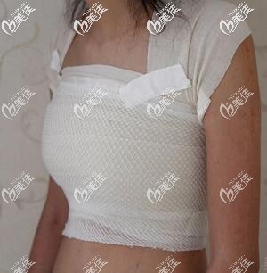 假体隆胸术后3天效果图 假体隆胸术后3天效果图