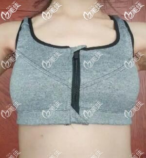 做假体隆胸术后25天效果图 做假体隆胸术后25天效果图