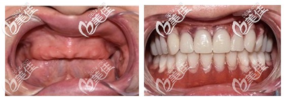 老爸种植全口牙前后效果对比照片 老爸种植全口牙前后效果对比照片