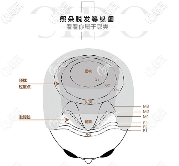 熙朵不同类型的脱发等级图