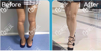 北京京民王志坚OX腿型矫正真人案例 北京京民王志坚OX腿型矫正真人案例