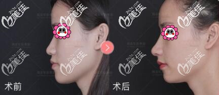 北京沃尔刘彦军假体隆鼻真人前后对比效果照