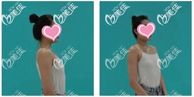 假体隆胸手术前 假体隆胸手术前