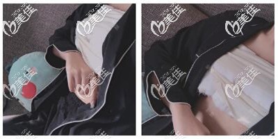 假体隆胸手术后第四天 假体隆胸手术后第四天