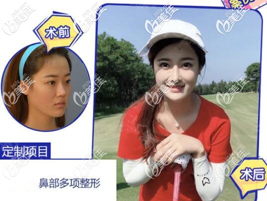 罗志敏隆鼻案例