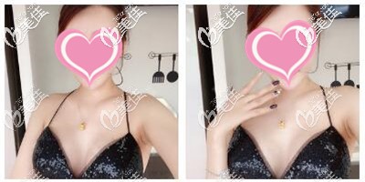 假体隆胸术后拆线 假体隆胸术后拆线