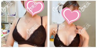 假体隆胸手术后一个月恢复效果 假体隆胸手术后一个月恢复效果