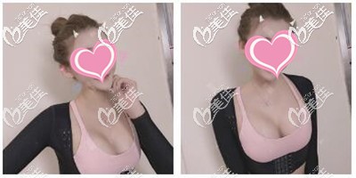 奉上平胸做了假体300cc隆胸手后效果图，也不算大的很夸张