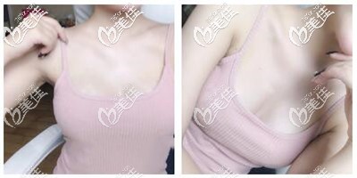 假体隆胸手术恢复半年效果 假体隆胸手术恢复半年效果